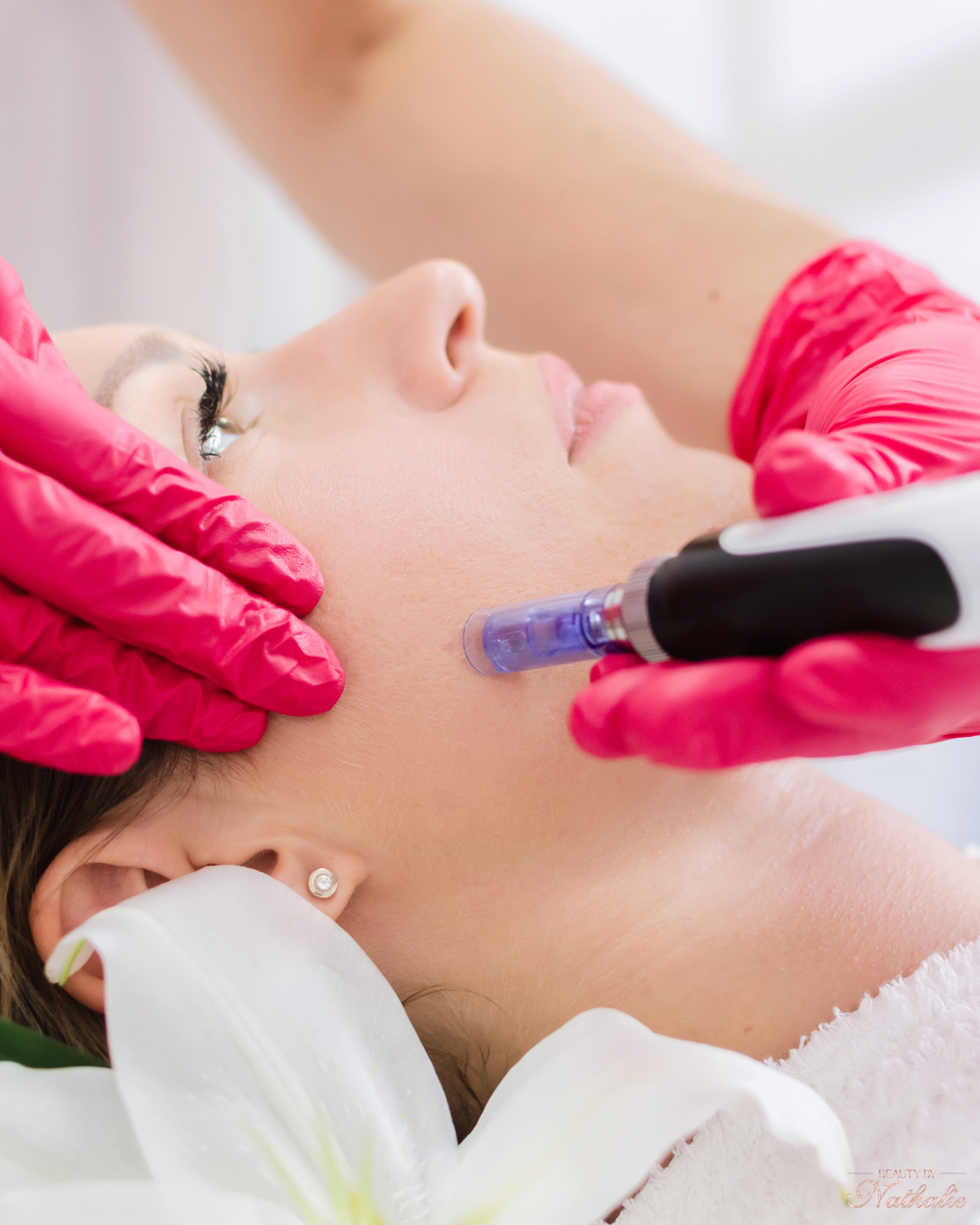 Djup Microneedling (Rejuvenation / Lifting / PDRN)